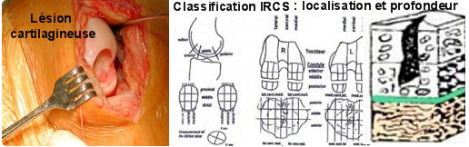 Qu'est qu’une lésion cartilagineuse ?