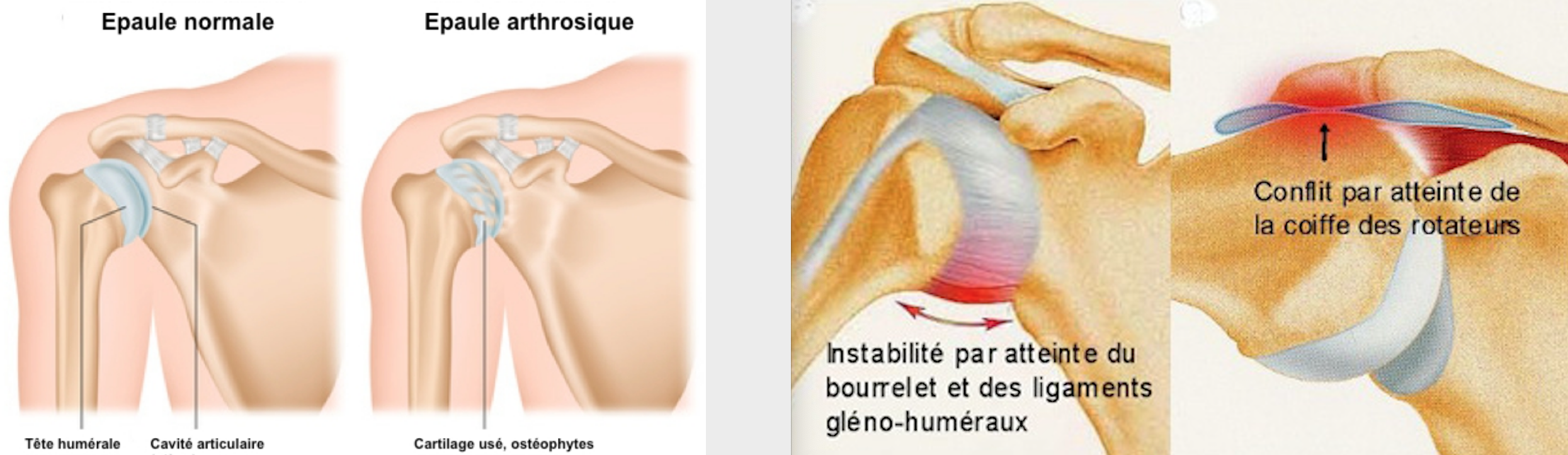 Douleurs de l'épaule - Dr Yves ROUXEL
