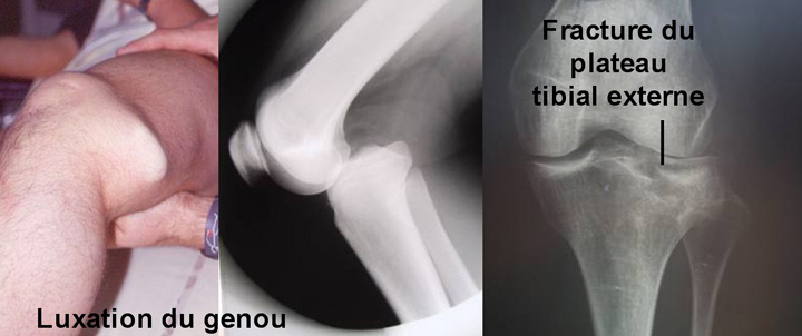 Douleurs du genou - Dr Yves ROUXEL