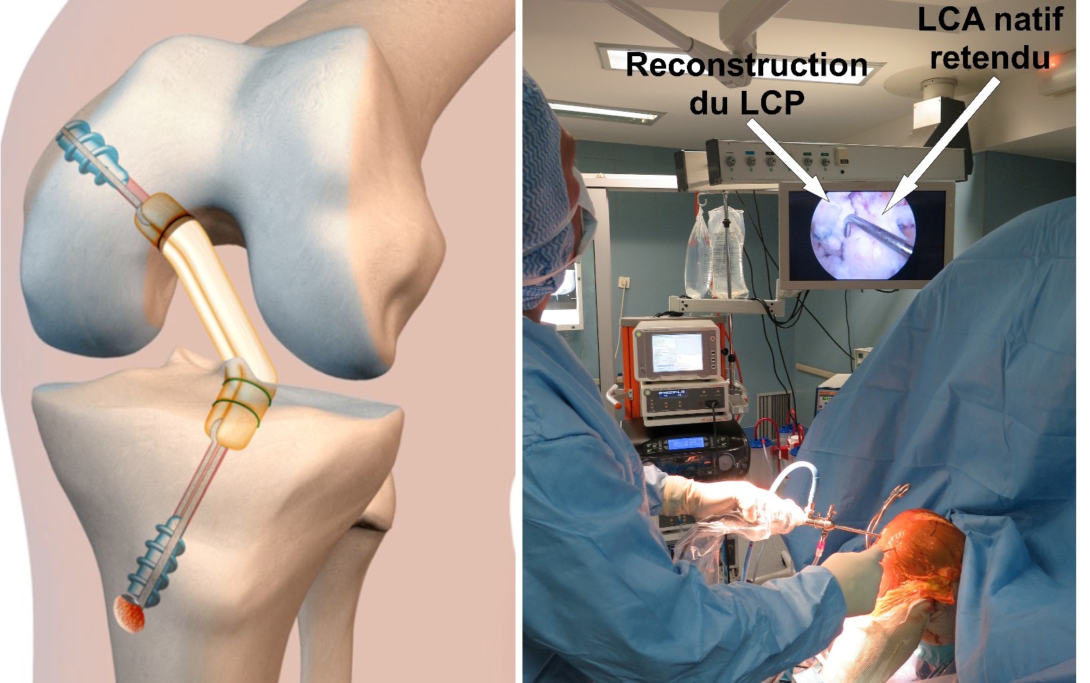 Chirurgie du ligament croisé postérieur - Dr Yves ROUXEL