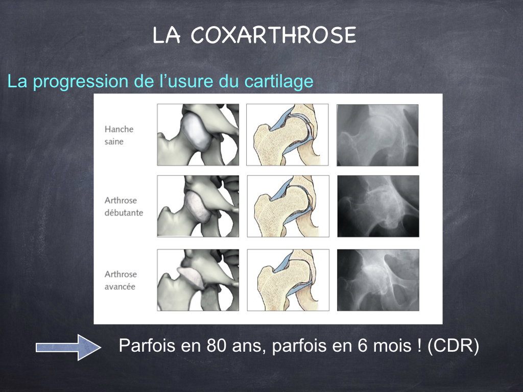 Une Femme Souffre De Douleurs À La Hanche. Le Concept De Traitement D'une  Articulation De La Hanche Pour Un Traumatisme, Une Plantation Ou Une  Arthrose. Banque D'Images et Photos Libres De Droits.