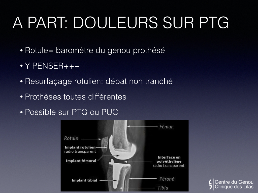 Douleurs et Instabilité de la rotule - Dr Yves ROUXEL