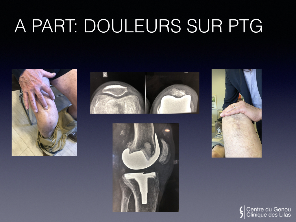 Instabilité et luxation de rotule - Nantes Chirurgie Jeunesse et Sport