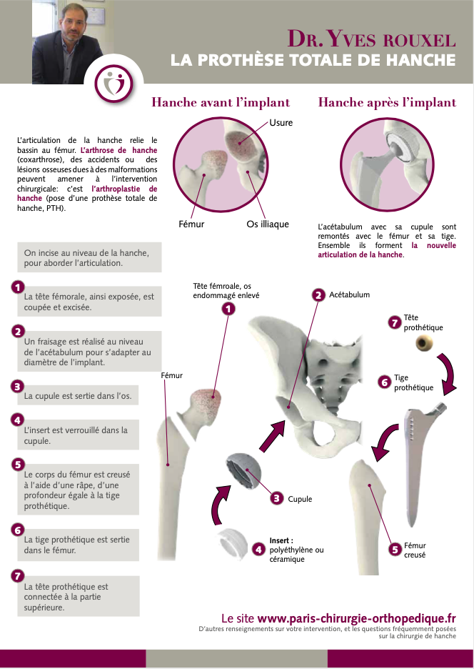 Prothèse totale de hanche - Dr Yves ROUXEL