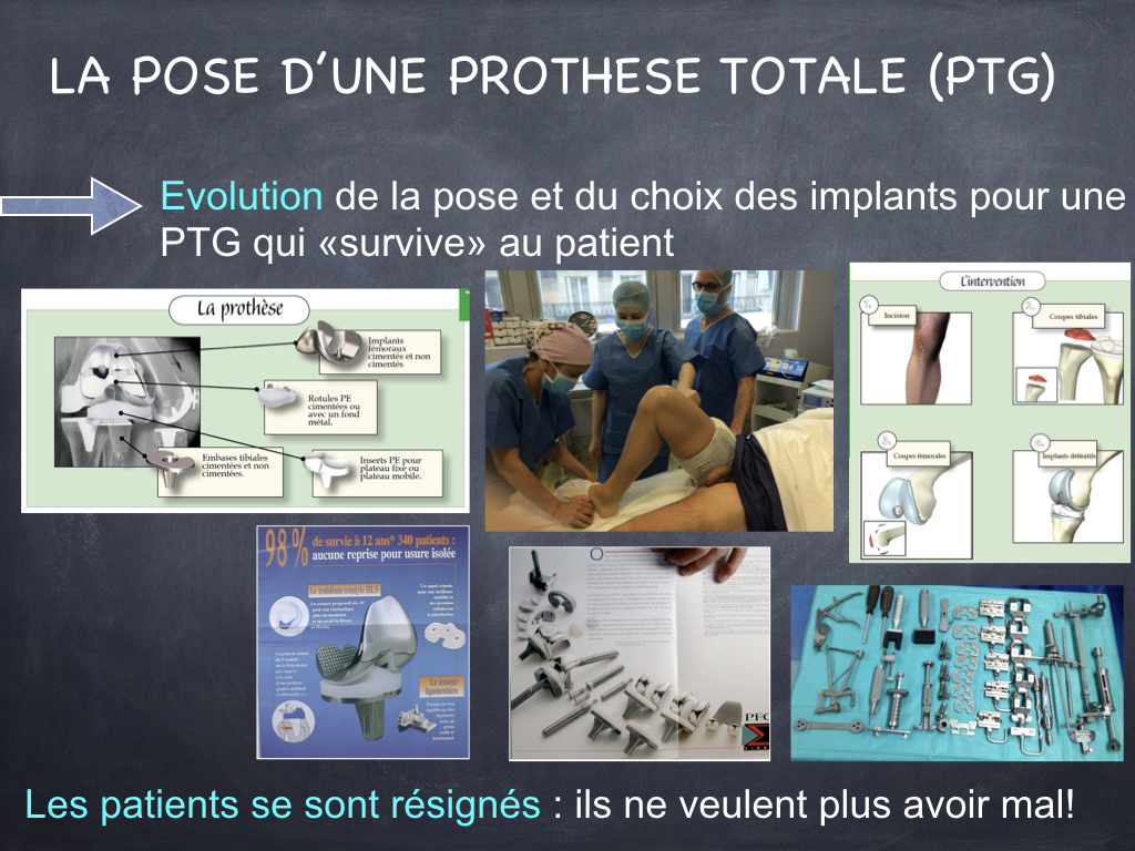 Prothèse totale de genou - Dr Yves ROUXEL