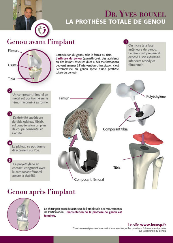 Arthrose du genou : quel est le bon moment pour se faire opérer ? : Femme  Actuelle Le MAG