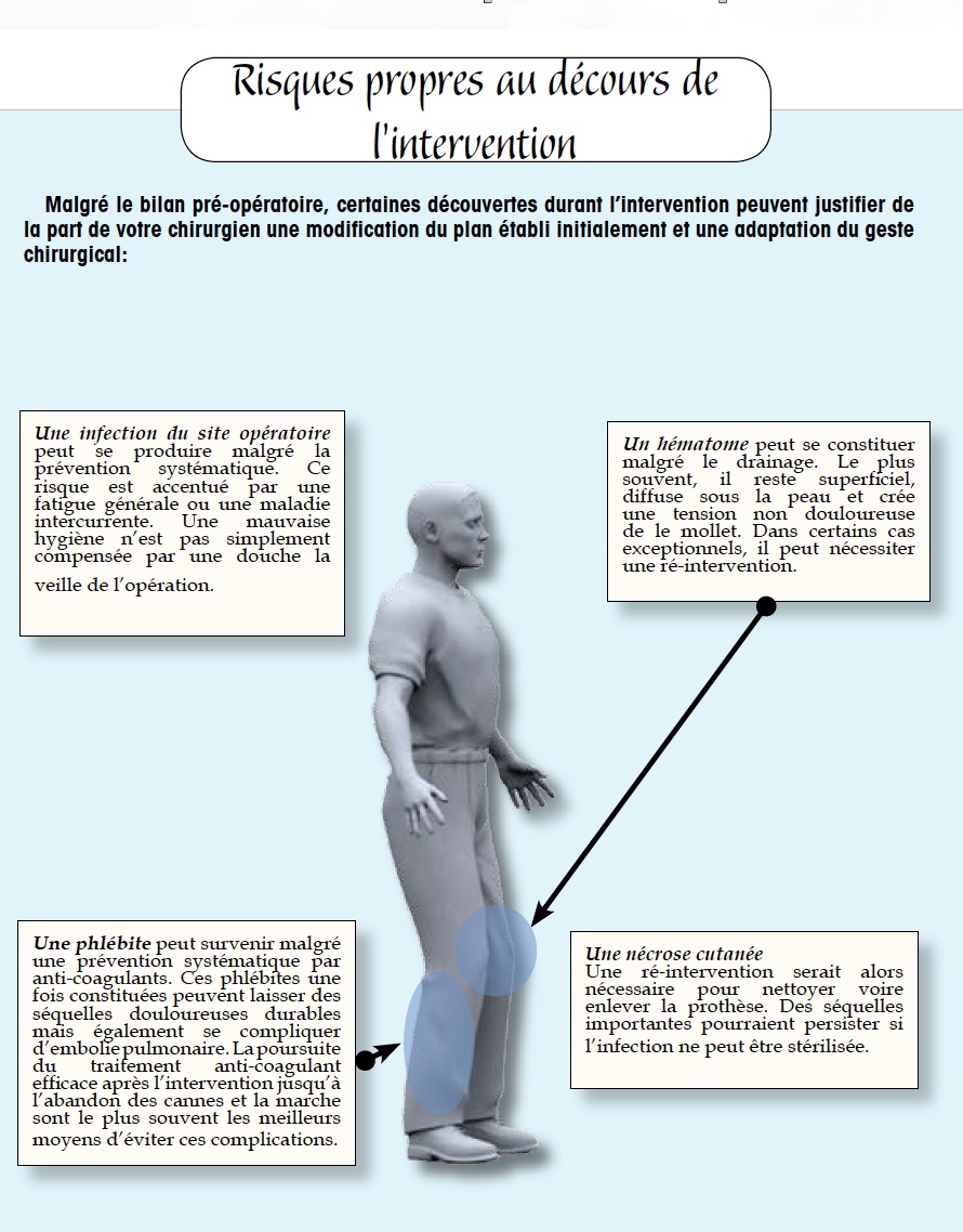 Prothèse totale de genou - Dr Yves ROUXEL