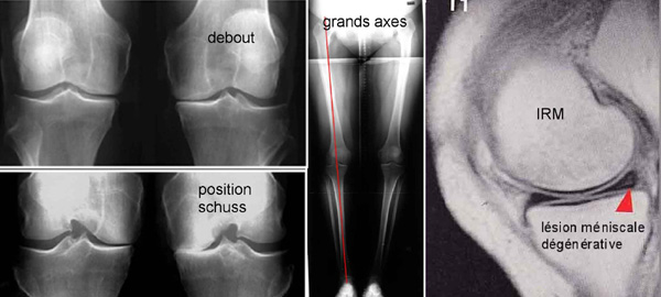 Arthrose du genou - Dr Yves ROUXEL