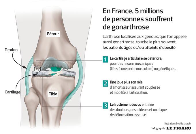 Arthrose du genou