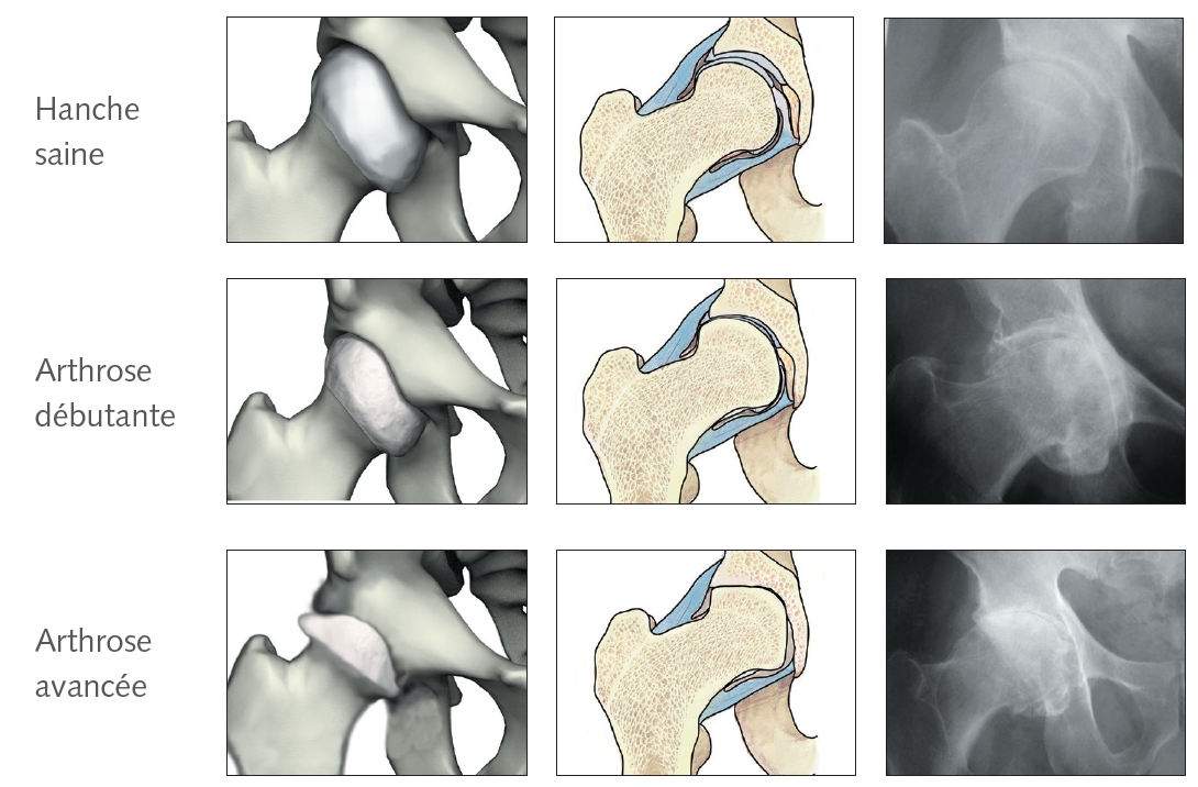 La coxarthrose