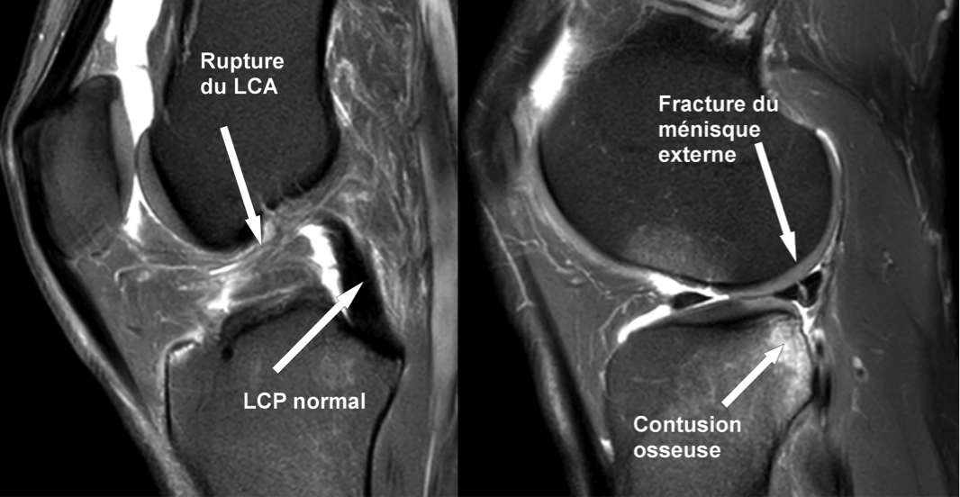 Chirurgie du ligament croisé antérieur - Dr Yves ROUXEL