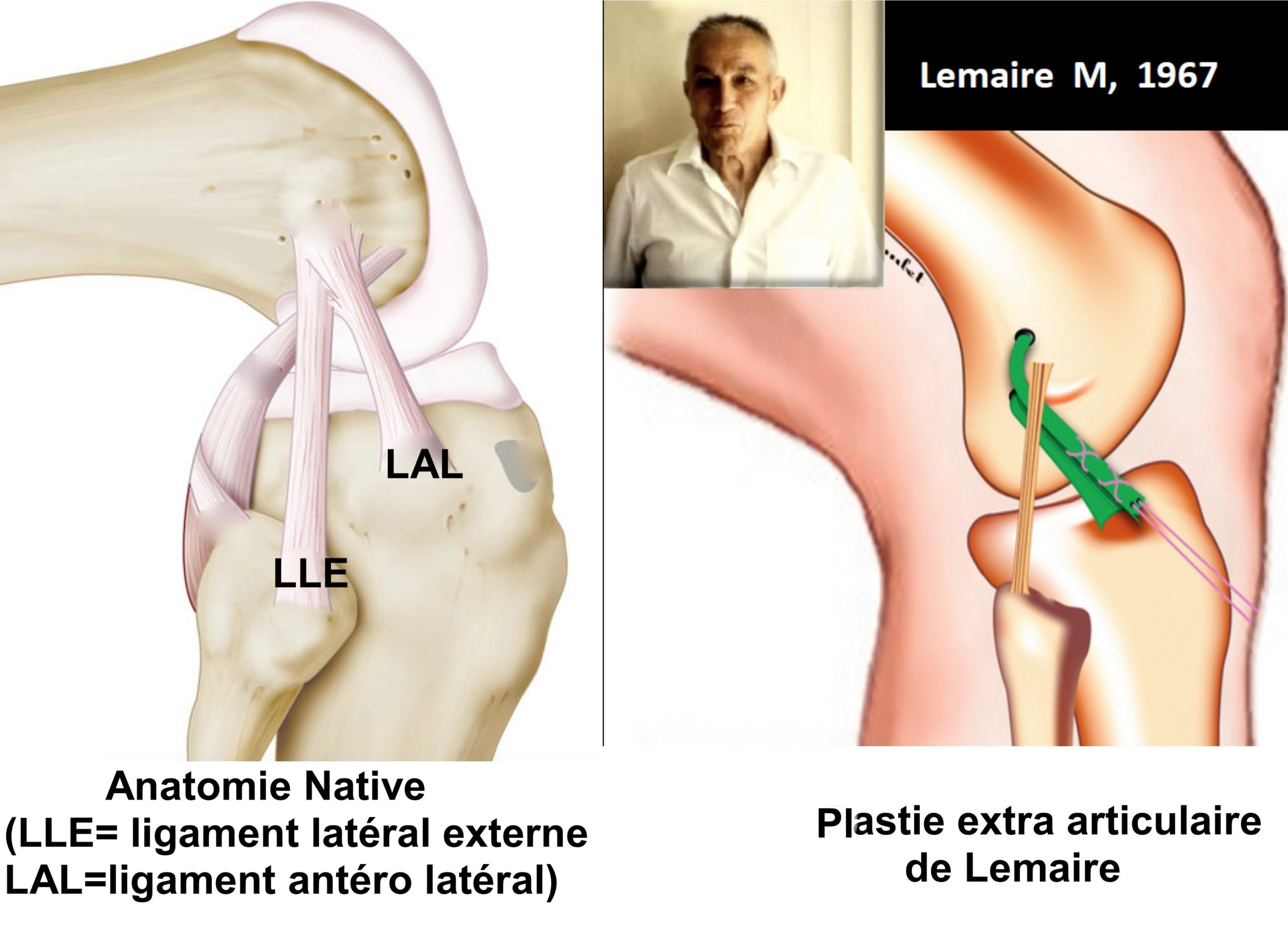 Chirurgie du ligament croisé antérieur - Dr Yves ROUXEL