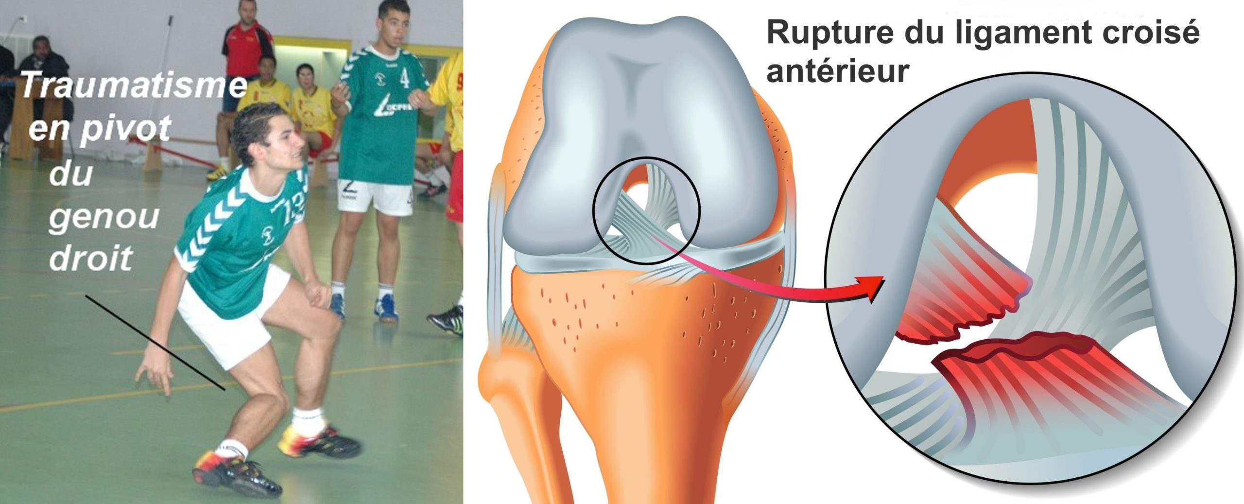 Chirurgie du ligament croisé antérieur - Dr Yves ROUXEL