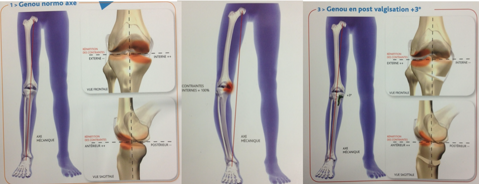 Arthrose du genou - Dr Yves ROUXEL