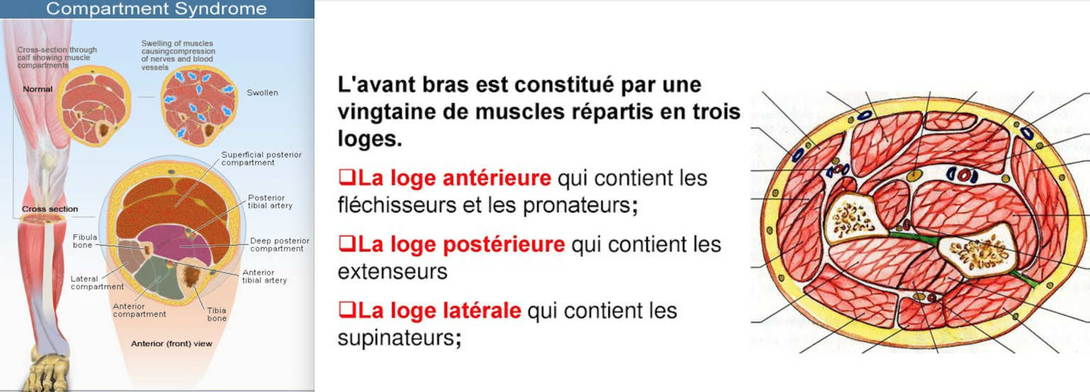 Syndromes de loges Dr Yves ROUXEL