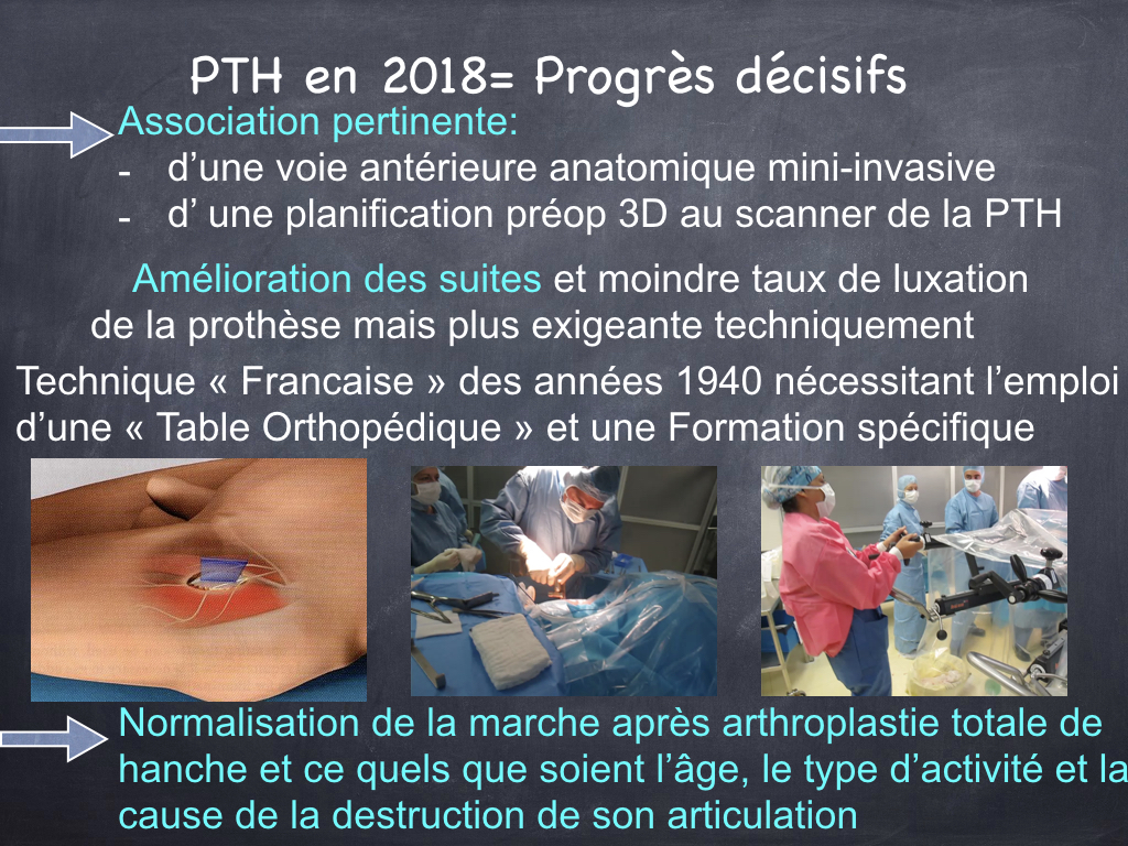 Prothèse totale de hanche - Dr Yves ROUXEL