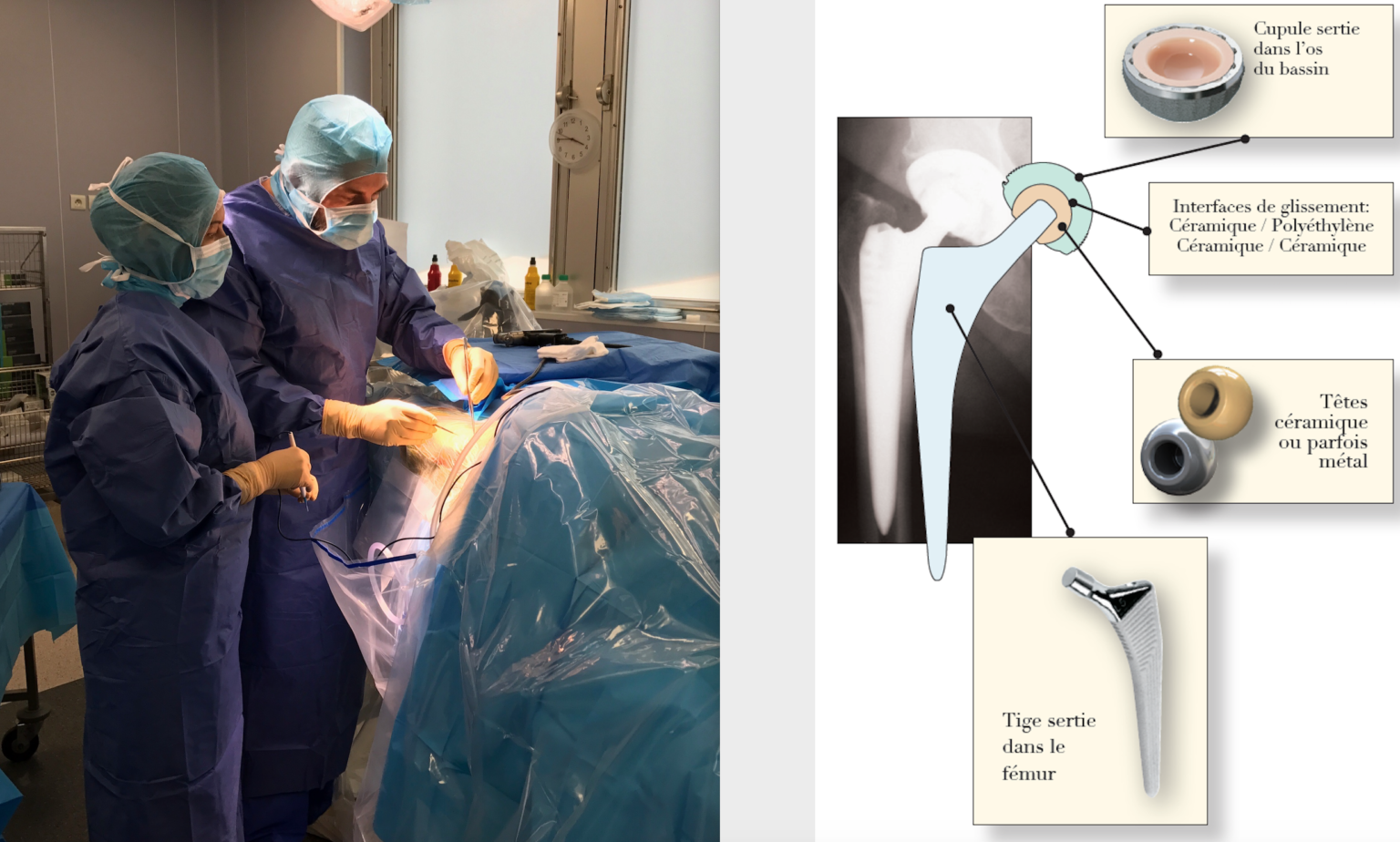 Rééducation après prothèse de hanche Dr