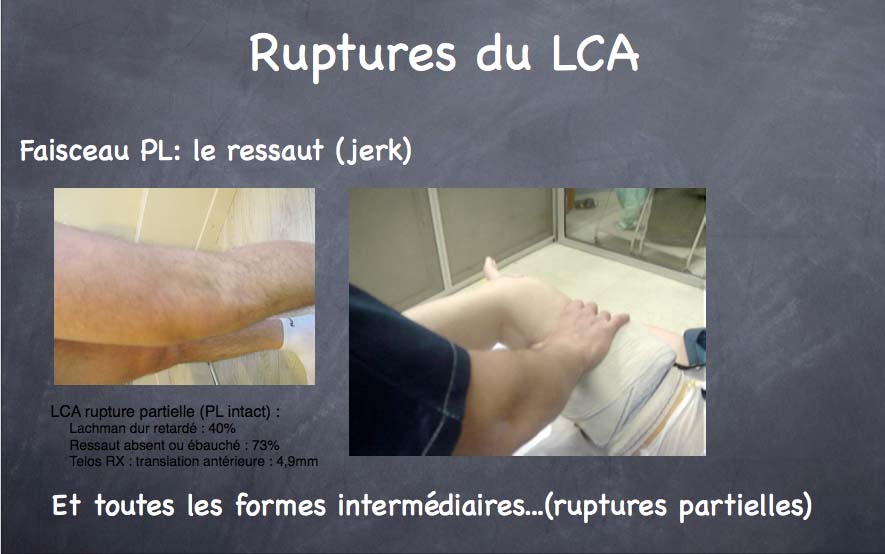 Chirurgie du ligament croisé antérieur - Dr Yves ROUXEL