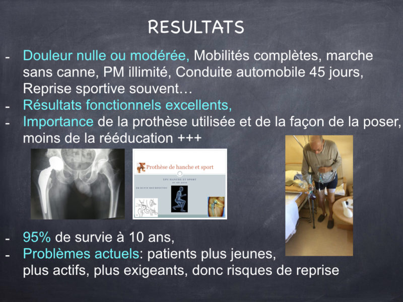 Mouvement Luxant Prothèse De Hanche Voie Antérieure