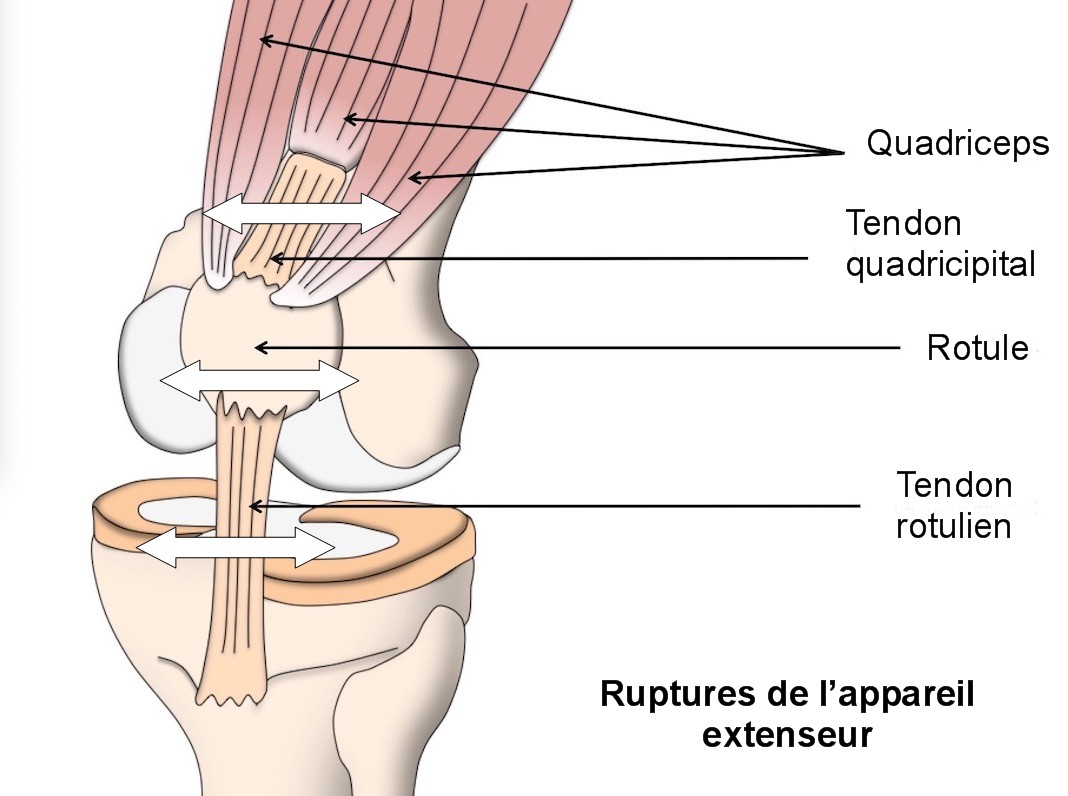 Rupture du tendon rotulien/tendon quadricipital - Dr Yves ROUXEL