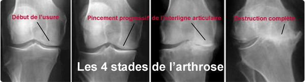 prothese-genou - Mon arthrose