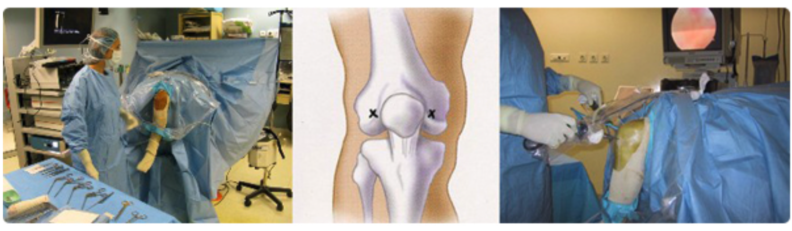 elfbar nachfüll pod läuft aus Chirurgie arthroscopique