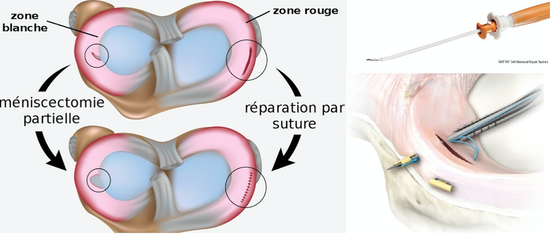 Chirurgie arthroscopique - Dr Yves ROUXEL